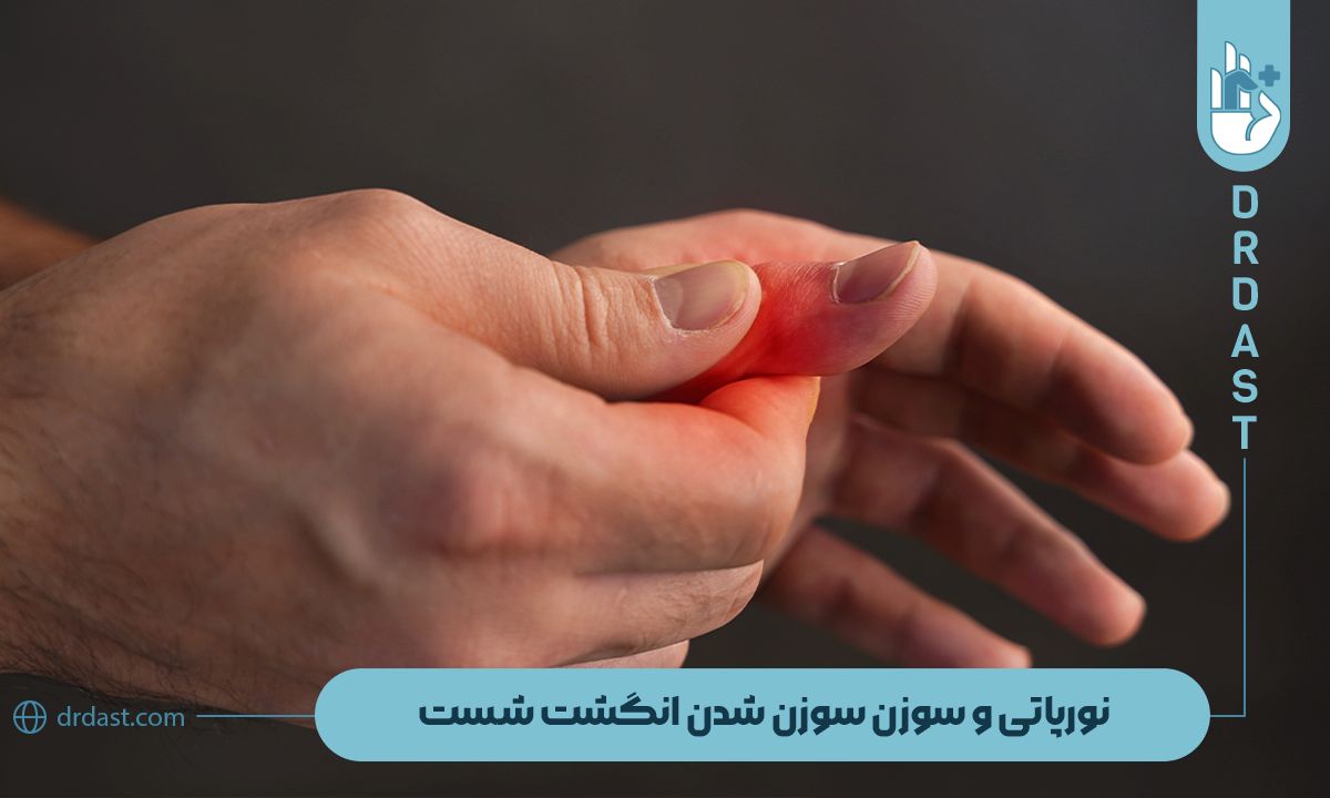 دمیلینه شدن و نوروپاتی محیطی